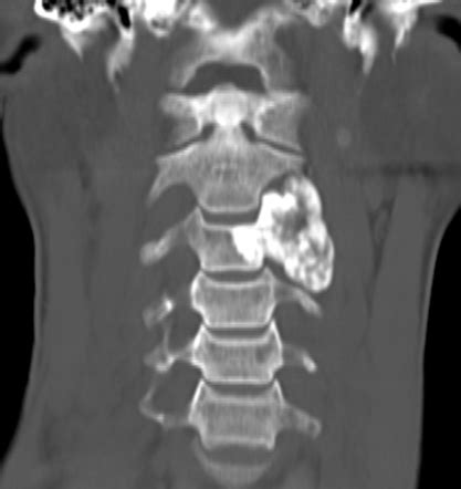 Osteoblastoma Spine