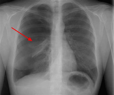 Pneumothorax - Causes, Signs, Symptoms, Treatment