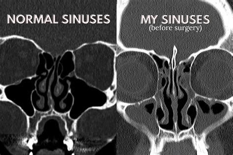 Jordan Hebl: The Truth About Sinus Surgery: My Experience