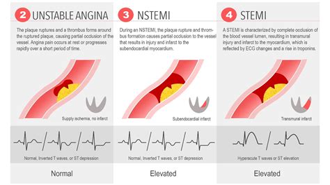 Acute Coronary Syndrome: USA vs NSTEMI vs STEMI | nstemi พยาธิสภาพ - CASTU