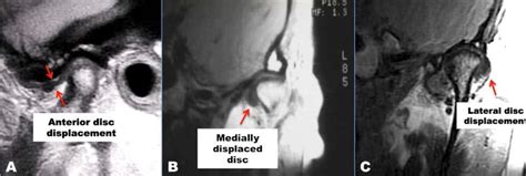 MRI-disc-TMJ - Larry M. Wolford, DMD