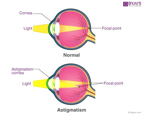 Astigmatism - Causes of Astigmatism and Types of Astigmatism | BYJU'S