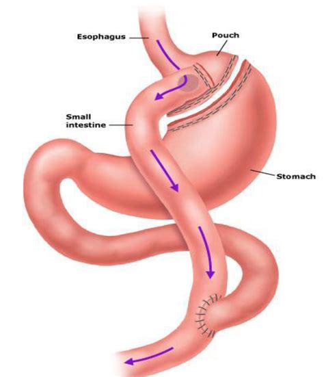 Vertical Gastric Sleeve Surgery for Long Term Weight Loss Diet