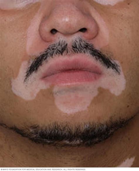 Vitiligo - Symptoms and causes - Mayo Clinic