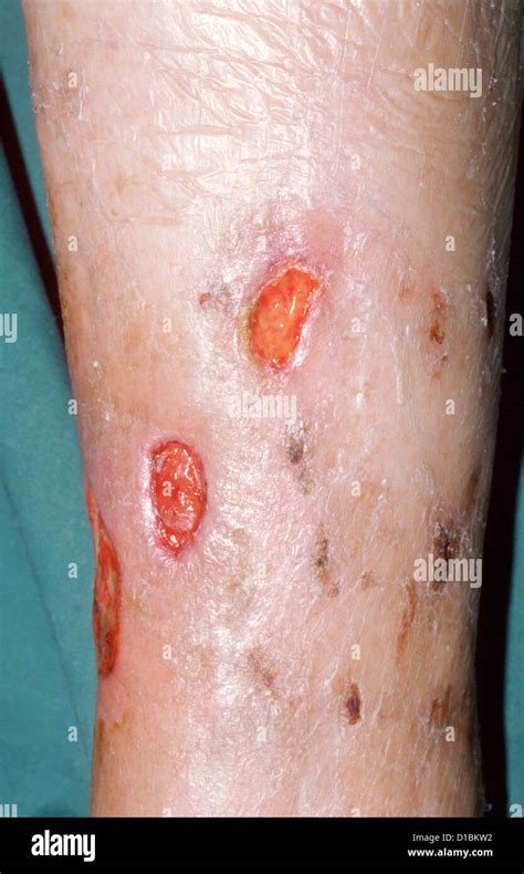 VASCULITIC ULCERS Stock Photo - Alamy