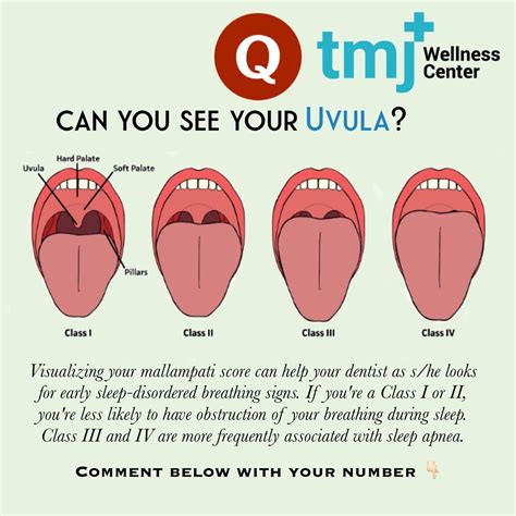 Physicians use a visual test called the mallampati score to both ...