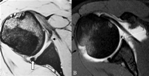 Bankart Lesion Mri