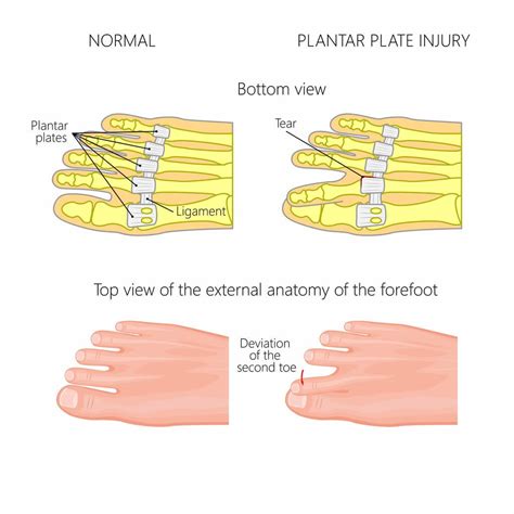 Plantar Plate Tear - Farnsworth Orthopedic Physical Therapy