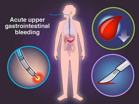 Urgent vs. Early Endoscopy for Acute Upper GI Bleeding | NEJM