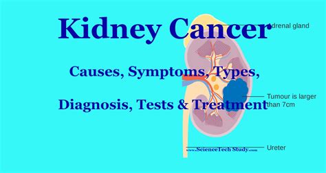 Kidney cancer: Symptoms, Causes, Diagnosis and Treatment