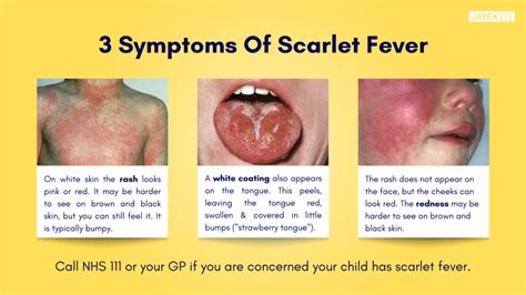 Strep A and Scarlet Fever Information - Munro Medical Centre