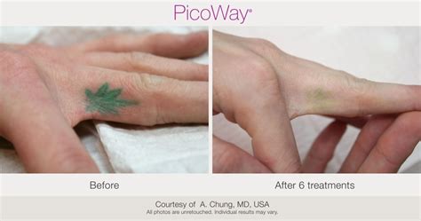 PicoWay Laser Tattoo Removal – Synergy Medical Aesthetics – Nanaimo ...