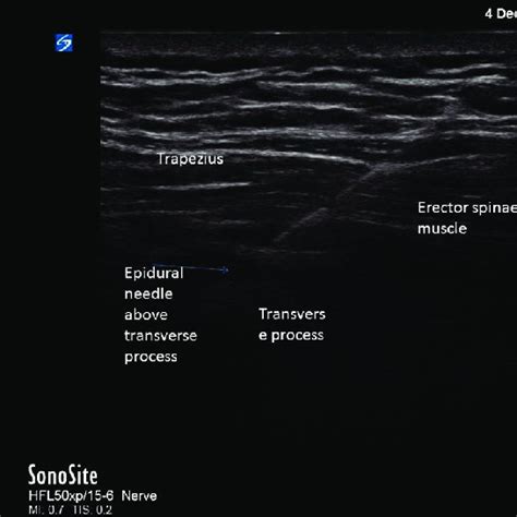 Showing the ultrasound-guided erector spinae plane block at T7 level ...