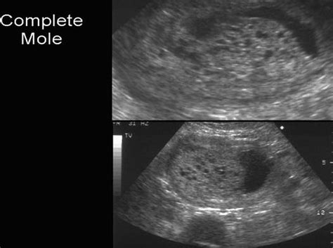 How Early Can A Molar Pregnancy Be Detected By Ultrasound - PregnancyWalls