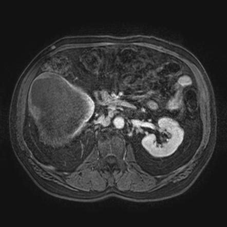 Renal Cell Carcinoma Mri