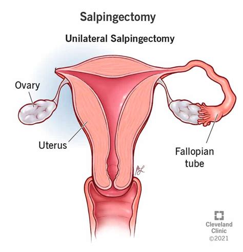 Salpingectomy: Purpose, Procedure, Risks & Recovery