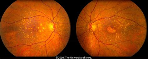 Macular Degeneration | Things Health