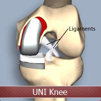 Unicompartmental Knee Replacement - Crovetti Orthopaedics