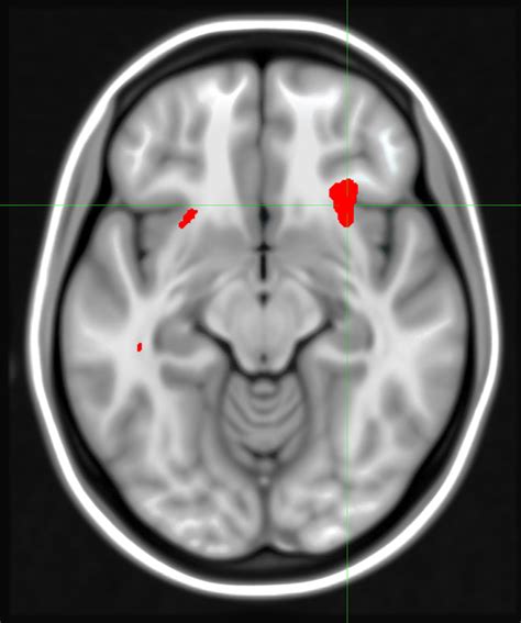 Brain Scan May Predict Best Depression Treatment | National Institutes ...