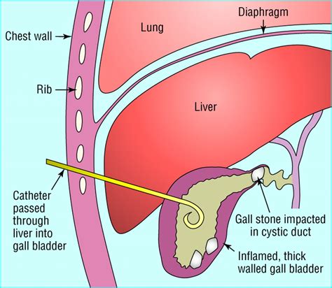 Percutaneous Drainage Of Gallbladder - Best Drain Photos Primagem.Org