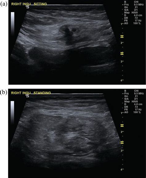 Ventral Hernia Ultrasound