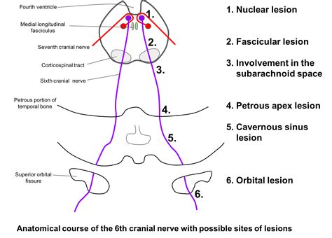 Cranial Nerve 6 Palsy