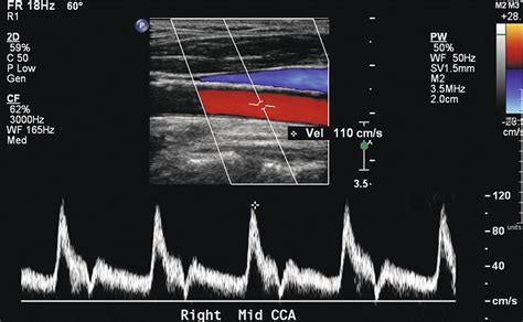 Carotid Endarterectomy Ultrasound