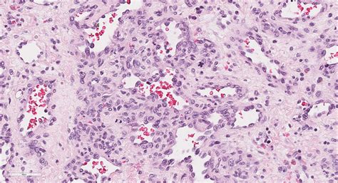 Hemangioma Histology