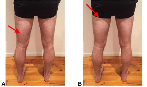 Hamstring Injury - Causes, Symptoms, Recovery Time & Treatment