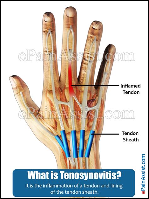 Synovitis and Tenosynovitis|Treatment|Recovery|Causes|Symptoms