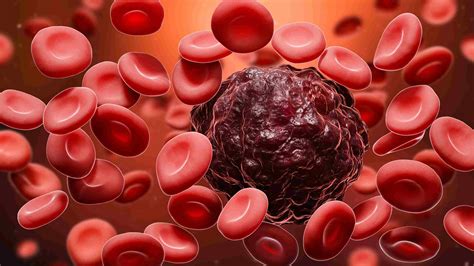 Understanding Common Types of Blood Cancer | Medanta | Medanta