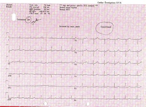 Electrocardiograph showing lengthened QTc interval | Download ...