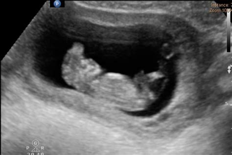 Anencephaly Ultrasound