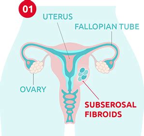 Types of Fibroids » 4 Types of Fibroids Explained — A/Prof Alex Ades