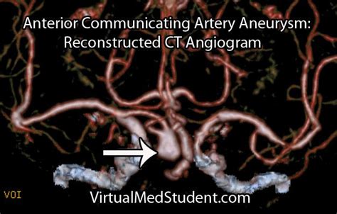 anterior communicating artery aneurysm symptoms - madalenegedeon