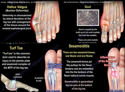 Differential Diagnosis of Big Toe Pain — OrthopaedicPrinciples.com