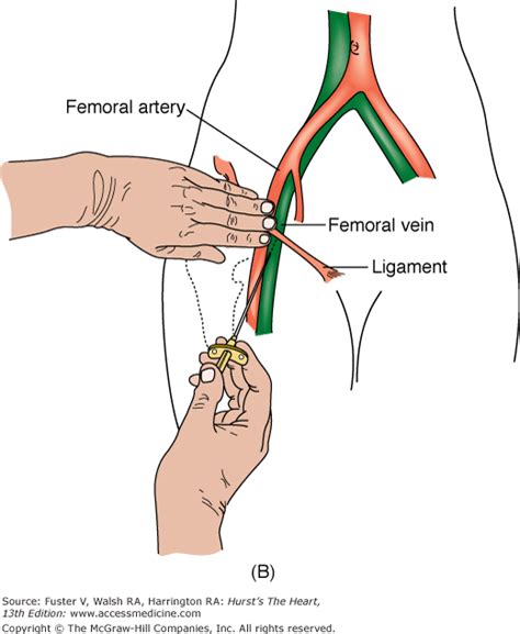 Cardiac Catheterization, Cardiac Angiography, and Coronary Blood Flow ...