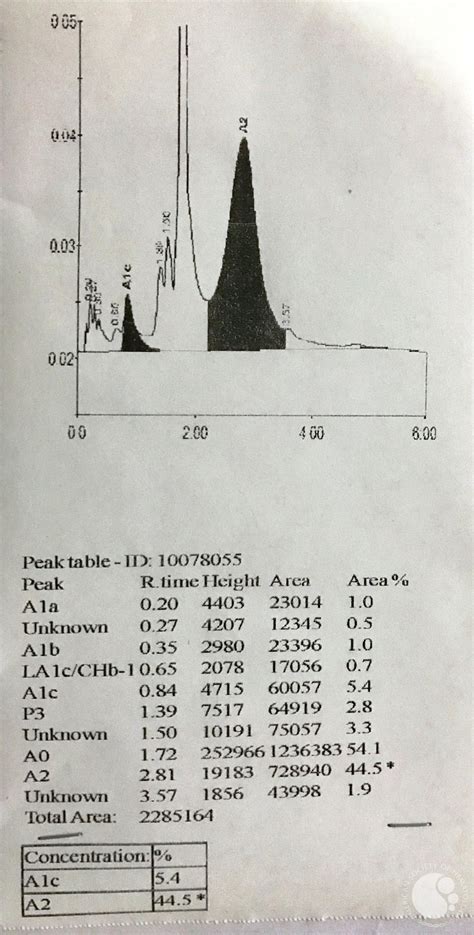 HPLC shows a peak of more than 40% in HbA2 retention window.