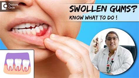 What Swollen Gums are telling you? Know its Home Remedies -Dr.Karthika ...