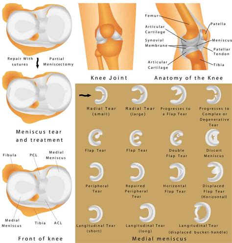 The Three Most Common Symptoms of Knee Meniscal Tears