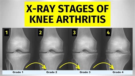 Knee Arthritis X-ray Stages: What You Need To Know - YouTube