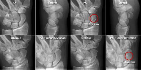 Scaphoid Fracture X Ray Views