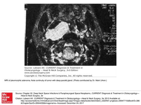 MRI of pleomorphic adenoma - ppt download