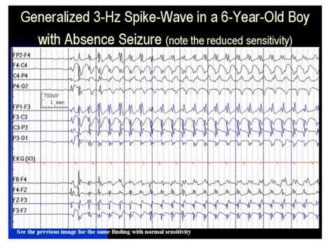 Abnormal EEG patterns