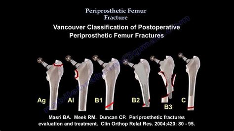 Intramedullary Nailing of Right Femur Fracture | closed fracture femur ...