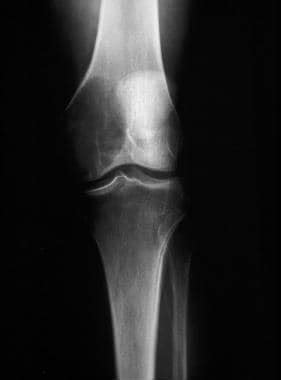 Giant Cell Tumor of Bone Workup: Radiography, Magnetic Resonance ...