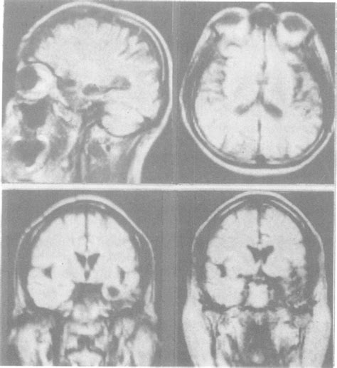 Case 2 MRI: the most affected areas side insula and the left temporal ...