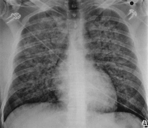 Clinical and Radiologic Features of Pulmonary Edema | RadioGraphics