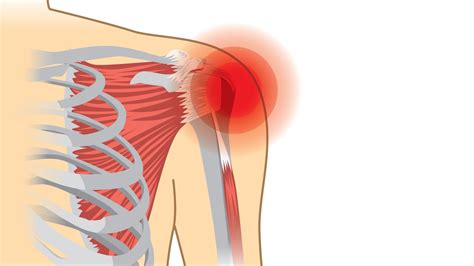 Rotator Cuff Tear Symptoms, Causes and Treatment