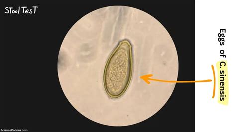 Clonorchis sinensis Infection2024: Symptoms, Diagnosis, and Treatment ...